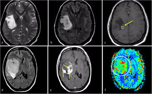 Características de imagen en dos pacientes con astrocitoma IDH-mutado grado 4. a-c) Paciente de 37 años. Axial T2w, FLAIR y T1w poscontraste. Extensa lesión bien definida hiperintensa en T2w (a) con la correspondiente hipointensidad en FLAIR y delgado borde hiperintenso periférico en (b), consistente con el signo de mismatch T2/FLAIR que sugiere mutación en IDH. Se observa un pequño foco de realce y necrosis dentro del margen profundo del tumor (c), lo que sugiere un grado 4. Obsérvese también que, en este caso, una biopsia que no captara la necrosis podría subestimar el grado del tumor y considerarlo de grado 2-3. La detección de características de imagen de grado 4 dentro de un tumor con mismatch T2/FLAIR parece ser una manifestación específica de astrocitoma IDH-mutado grado 4. d-f) Paciente de 49 años. FLAIR axial (d), T1w poscontraste (e), y mapa de color de CBV derivado de DSC-PWI (f). Masa tumoral bien definida y redondeada en FLAIR (d) con áreas internas de realce sólido (e) dentro del tumor no captante. Pequeños focos de necrosis (flechas en e) y CBV claramente elevado (círculo en f). Cabe destacar que existía una necrosis más extensa en otras partes del tumor que no aparecen en esta figura. Un glioma con aspecto de grado 4 en un paciente menor de 55 años con algunas características atípicas para un glioblastoma, como una morfología redondeada clara y márgenes bien definidos, podría sugerir un astrocitoma IDH-mutado grado 4 CBV: volumen sanguíneo cerebral; DSC-PWI: imagen de perfusión dinámica; IDH: gen isocitrato deshidrogenasa.