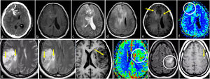 Oligodendrogliomas IDH-mutados 1p/19q codeleccionados grado 2-3. a-f) Paciente de 53 años. TAC axial sin contraste (a), T1w (b), T2w (c), FLAIR (d), T1w poscontraste (e) y mapa de color de CBV (f). Masa bifrontal difusa mal definida con extensa infiltración cortical (c y d) y señal heterogénea en T1w y T2w (b y c). Calcificaciones prominentes en TAC (a). Realce irregular muy sutil (flechas en e) y áreas de CBV elevado (círculo en f). g-h) Paciente de 52 años. Axial T2w (g) y FLAIR (h). Masa parietal infiltrante mal definida con señal heterogénea y extensa infiltración cortical (g-h). Presencia de pequeñas áreas intratumorales sin realce con intensidad de señal sugestiva de líquido, compatibles con focos quísticos (flechas en g y h). i-j) Paciente de 38 años. T1w axial (i) y mapa de color de CBV (j). Ejemplo de un pequeño quiste intratumoral en T1w (flecha en i) y CBV claramente elevado (j). k-l) Paciente de 35 años. FLAIR axial (k) y T1w post-contraste (l). Masa infiltrante mal definida e hiperintensa en FLAIR claramente centrada en la corteza y siguiendo su morfología giriforme: signo de cortex continuo (círculo en k). Pequeños focos asociados de realce sólido (flecha en l). Obsérvese también la ausencia del signo de mismatch T2/FLAIR en c-d y g-h. CBV: volumen sanguíneo cerebral; IDH: gen isocitrato deshidrogenasa; TAC: tomografía axial computarizada.