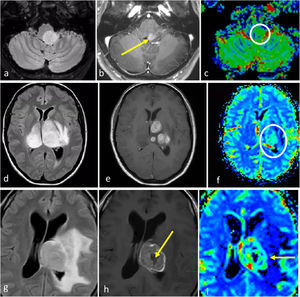 Gliomas difusos de línea media H3K27M-alterados. a-c) Paciente de 52 años. FLAIR axial (a), T1w poscontraste (b) y mapa de color de CBV (c). Glioma troncoencefálico, ligeramente paramediano, nodular y bien definido en FLAIR (a), con focos de realce (flecha en b) y CBV ligeramente elevado (círculo en c). d-f) Paciente de 48 años. FLAIR axial (d), T1w poscontraste (e) y mapa de color de CBV (f). Masa infiltrante bitalámica hiperintensa en FLAIR (d) con realces nodulares sólidos multifocales (e) y CBV elevado. g-i) Paciente de 33 años. FLAIR axial (g), T1w poscontraste (h) y mapa de color de CBV (i). Masa talámica hiperintensa en FLAIR con edema extenso (g), realce irregular en anillo grueso con necrosis central (flecha en h) y CBV elevado en la periferia (flecha en i). CBV: volumen sanguíneo cerebral.