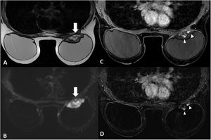 Imágenes de RM mamaria. A)Secuencia potenciada en T2. La masa (flecha) presentaba unos bordes circunscritos, con señal heterogénea, predominantemente hiperintensa, localizada en la región posterior de la prótesis mamaria. B)Secuencia de difusión, donde se visualizaba una marcada restricción de la lesión (flecha). C,D)Secuencia potenciada en T1 tras la administración de contraste intravenoso (gadolinio) e imagen de sustracción post-contraste. Se visualizaba un realce precoz e intenso, de morfología nodular periférica y serpiginosa, en el interior de la lesión (puntas de flecha). En la mama derecha no se identificaron alteraciones reseñables.