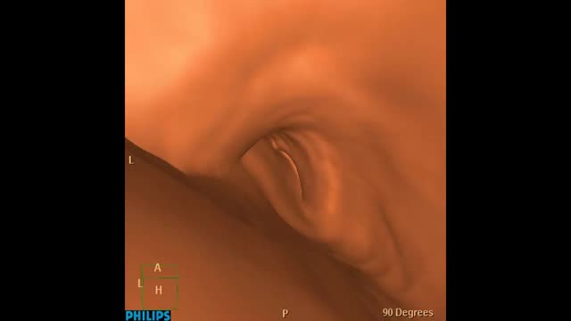 https://ars.els-cdn.com/content/image/1-s2.0-S003383382300098X-mmc1.mp4