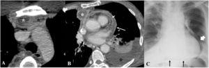 Complicaciones del mediastino y del pericardio. A)Paciente intervenido de segmentectomía apical derecha con fiebre y leucocitosis. En la TC axial se observa trabeculación de la grasa mediastínica (asterisco negro) con una pequeña colección incipiente (asterisco blanco) compatible con mediastinitis. B)Paciente intervenido de lobectomía superior derecha con clínica infecciosa. La TC axial muestra una colección mediastínica hipodensa (asterisco blanco), engrosamiento y realce de ambas hojas pericárdicas (flechas blancas) y derrame pericárdico, hallazgos compatibles con absceso mediastínico con pericarditis secundaria. Obsérvese el moderado derrame pleural izquierdo (asterisco negro). C)Radiografía de tórax en paciente intervenido de segmentectomía postero-basal derecha identificándose neumopericardio (flecha blanca) con el signo del diafragma continuo (flechas negras).