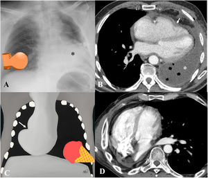 Herniación cardíaca. A,B)Hernia cardíaca izquierda. A)La radiografía de tórax muestra una silueta cardiaca completamente a la izquierda de la línea media (asterisco), horizontalizada y con morfología en «bota aplanada». B)En la TC axial se confirma la horizontalización del corazón, con indentación en la pared libre del ventrículo derecho (flecha) que traduce el punto de estrangulación por los bordes del defecto pericárdico. Obsérvese el contenido hidroaéreo en la cámara de neumonectomía (asterisco). C-D)Hernia cardíaca derecha. C)La ilustración muestra la situación anómala de la silueta cardíaca, visualizando la impronta del pericardio residual por donde se hernia el corazón (flecha), adoptando la morfología en «cono de helado». D)La TC axial demuestra el desplazamiento completo del corazón hacia la derecha.
