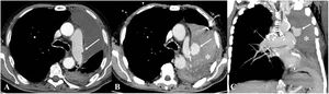 Pseudoaneurisma de la arteria pulmonar. A)TC axial de tórax 2semanas después de una lobectomía superior izquierda en la que se observa una pequeña alteración del contorno de la arteria pulmonar izquierda (flecha). B,C)Tres semanas más tarde, el paciente presenta disnea y mal estado general. Las imágenes de TC axial (B) y coronal (C) MIP muestran un pseudoaneurisma sacular dependiente de la arteria pulmonar principal izquierda (flecha) y un voluminoso hemotórax izquierdo por rotura del pseudoaneurisma (asterisco).