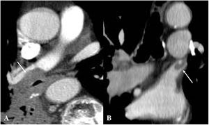 Trombosis del muñón arterial y venoso. A)La TC axial demuestra un defecto de repleción en el muñón arterial pulmonar (flecha) en un paciente intervenido de lobectomía inferior derecha. C)TC coronal de un paciente intervenido de lobectomía superior izquierda en la que se observa un pequeño trombo en el muñón de la vena pulmonar superior izquierda (flecha).