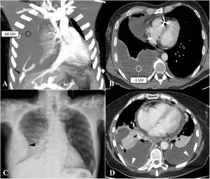 Complicaciones pleurales: hemotórax, quilotórax y empiema posquirúrgico. A)Angio-TC coronal MIP que evidencia abundante líquido pleural con valores de atenuación altos y extravasación activa de contraste (flecha) compatible con hemotórax con datos de sangrado activo. B)TC axial donde se observa derrame pleural derecho de moderada cuantía con valores de atenuación bajos. El análisis bioquímico reveló un quilotórax. C)Radiografía y D)TC axial de distintos pacientes con empiema posquirúrgico. La radiografía muestra una colección de morfología biconvexa (cabeza de flecha). En la TC se visualizan colecciones líquidas bilaterales con burbujas de gas (flechas), así como engrosamiento y realce pleural (cabezas de flecha).