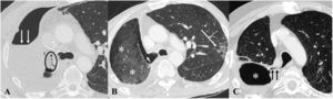 Fístula broncopleural. A)TC axial tras una neumonectomía derecha en la que se identifican pequeñas burbujas de gas (círculo) rodeando al muñón bronquial y un nivel hidroaéreo (flechas) en la cavidad pleural. B)Cuatro semanas más tarde se aprecia un amplio defecto en el muñón bronquial (flecha corta). Al paciente se le realizó una toracotomía con relleno de la cavidad pleural con gasas (asteriscos). Obsérvese la opacidad subpleural izquierda (flecha larga) de naturaleza infecciosa. C)TC axial en otro paciente distinto, intervenido de lobectomía superior derecha 10semanas antes, en la que se observa un trayecto fistuloso (flechas) entre el muñón bronquial y la cavidad pleural (asterisco) compatible con una fístula broncopleural.