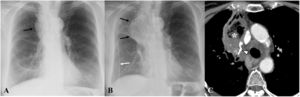 Hematoma mediastínico. A)Radiografía de tórax a los 3días de una linfadenectomía hiliomediastínica, donde se intuye un ensanchamiento mediastínico (flecha). C)Seis días después, el ensanchamiento mediastínico es más evidente (flechas negras). Nótese el tubo de tórax de nueva colocación (flecha blanca). D)La TC axial confirma una colección heterogénea (asterisco) en el mediastino anterior adyacente a los clips quirúrgicos (cabeza de flecha) en relación con un hematoma mediastínico.