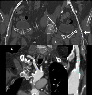 A-D) TCMD con contraste con reconstrucción multiplanar curva. A y B) Arterias ilíacas comunes y externas, y femorales comunes, con placas ateroscleróticas calcificadas a lo largo de toda su longitud. Lesión aterosclerótica calcificada en la arteria femoral común izquierda (flecha). C) Segmento proximal del tronco braquiocefálico derecho con gruesas placas ateroscleróticas que causan estenosis severa de su luz. D) Segmento proximal de la arteria carótida común izquierda con lesión aterosclerótica calcificada proximal y estenosis severa de su luz.