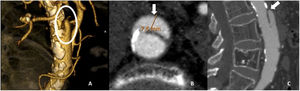A-C) TCMD y volumen rendering (VR) con contraste de otro paciente que muestra una disección aórtica de la porción infrarrenal de la aorta abdominal, con una luz falsa de 7,5mm de espesor, con un diámetro aórtico a nivel de disección normal.