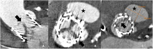 A) TCMD con sincronización con reconstrucción en un plano coronal doble oblicuo centrado en la prótesis valvular aórtica donde se identifica engrosamiento de los velos (flecha). B) TCMD con sincronización y reconstrucción axial en un plano doble oblicuo centrado en la prótesis valvular aórtica del mismo paciente donde se observa el engrosamiento de los velos de la prótesis (flecha) y un seudoaneurisma (estrella). C) TCMD con sincronización y reconstrucción axial en un plano doble oblicuo centrado en la prótesis valvular aórtica tras tratamiento anticoagulante donde se observa disminución del engrosamiento de los velos (flecha) y persistencia del seudoaneurisma (estrella). En este paciente se decidió realizar posteriormente un procedimiento Valve-in-Valve debido al mal funcionamiento de la prótesis por la trombosis previa.