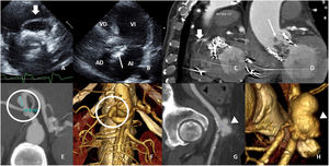 A y B) Ecocardiografía transtorácica, imagen A) centrada en absceso cardiaco y B) plano apical del corazón (plano 5 cámaras). Imagen anecoica en el anillo protésico anterior, de 40×20mm y sin flujo en el interior, sugestiva de absceso (flecha gruesa). Así mismo, imagen hiperecoica móvil, adyacente a la pared septal de la aurícula derecha (flecha fina). C y D) Mismo paciente con TCMD con reconstrucciones oblicuas, C) imagen centrada en el diámetro máximo del absceso y D) imagen coronal doble oblicuo de la válvula aórtica. Múltiples abscesos periprotésicos en forma de pequeñas hipodensidades que se extienden hasta los límites del tracto de salida del ventrículo izquierdo (flecha fina) y un absceso de 22mm justo debajo del ostium coronario derecho (flecha gruesa). E-H) Mismo paciente con TCMD con reconstrucciones multiplanar curva (E y G) y volume rendering (VR) (F y H). Bifurcación del tronco celíaco con dilatación sacular de 16mm de diámetro que presenta un cuello corto y estrecho (círculo). Arteria femoral común con aneurisma sacular de aspecto micótico que presenta contornos lobulados, engrosamiento circunferencial de su pared y reticulación de la grasa adyacente (punta de flecha).