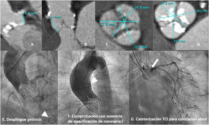 A y B) TCMD con reconstrucciones MPR. El paciente A presenta una baja altura del ostium del seno coronario izquierdo, con una distancia <12mm mientras que el paciente B tiene una distancia >12mm al ostium coronario derecho desde la inserción del velo valvular. C y D) TCMD con reconstrucciones MPR. A la izquierda, presentamos un paciente con un diámetro de seno aórtico <30mm (factor de riesgo), mientras que a la derecha vemos un paciente con un diámetro >30mm. E-G) Imágenes de un procedimiento TAVI con oclusión aguda de la arteria coronaria izquierda y la colocación de un stent en el mismo procedimiento. E) Despliegue de la prótesis con extremo distal del catéter en VI (punta de flecha). F) Se retira el catéter de la aorta ascendente (punta de flecha) y se inyecta contraste para comprobar el éxito de la técnica, observando la obstrucción del tronco coronario izquierdo (TCI). G) Se cateteriza el TCI (flecha) y se inyecta contraste yodado con correcta opacificación y posterior despliegue de un stent.