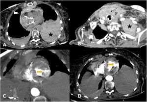 A) TC con cortes axiales sin contraste y B) en fase arterial, tras la administración de contraste. Hemopericardio (cabeza de flecha), hemotórax bilateral (predominantemente izquierdo, estrellas) y hemomediastino que se extiende hasta el nivel cervical. La imagen A también muestra la válvula protésica colocada correctamente. C y D) Reconstrucción en el eje corto de ambos ventrículos (C) y corte axial (D) en la fase arterial. Perforación ventricular izquierda en el segmento apical lateral (flecha amarilla) y extravasación con contraste que delinea el epicardio.