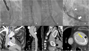 A-C) Procedimiento TAVI con control fluoroscópico. A) Prótesis parcialmente desplegada en la aorta por migración durante el procedimiento. B y C) Se consigue enfundar de nuevo la prótesis en el catéter para posteriormente reintentar su implante. D) Control fluoroscópico de la implantación de una segunda prótesis intraprocedimiento (flecha) debido a una posición inadecuada de la primera (punta de flecha). E-H) Reconstrucción de MPR curvo y MIP MDCT. TAVI con extremo distal insuficientemente expandido. La segunda prótesis migró al arco aórtico con un extremo distal adyacente al ostium de la arteria carótida común izquierda. Se identifica una imagen sugestiva de flap intimal en el extremo proximal de la prótesis migrada (flecha amarilla).