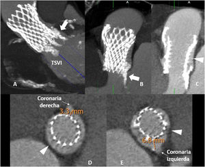 A-C) TCMD con reconstrucciones doble oblicuas y MIP tras la administración de contraste. A) Imagen centrada en el tracto de salida y en la colocación de la prótesis, B y C) imágenes en el plano coronal de la prótesis. La presencia de abundante calcio anular/subanular (flecha) condiciona la coaptación incompleta del anclaje proximal de la endoprótesis con la pared y la presencia de contraste entre la endoprótesis y la pared a ese nivel debido a una posible fuga periprotésica (puntas de flecha). D y E) Celdas de la endoprótesis a unos 7mm del ostium de la arteria coronaria izquierda y a unos 3mm del ostium de la arteria coronaria derecha.