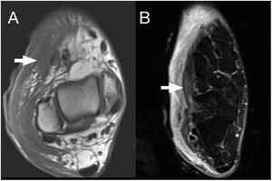 Paciente de 40 años, que ingresa tras desembarcar con deshidratación hipernatrémica severa, insuficiencia renal aguda y signos de rabdomiólisis. Presenta edema del miembro inferior derecho. Se le realiza RM con contraste, para descartar colecciones y osteomielitis objetivándose en secuencias axial ponderada en T1 y axial DP con saturación grasa, líquido en grasa subcutánea (flecha blanca) y discreto edema de musculatura local (flecha blanca), sin colecciones, compatible con «pie de patera».