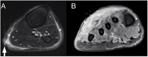 Paciente de 31 años que es remitido a las 24 h de haber desembarcado de patera, por cuadro de hipoglucemia y dolor en miembro inferior izquierdo y miembro superior derecho. A la exploración, presenta extensa celulitis en cara pretibial izquierda con flictenas y edematización y úlcera en región gemelar, así como edema y rubor en mano derecha. Con el diagnóstico de rabdomiólisis y sepsis de origen cutáneo se le solicita RM. Imágenes axiales ponderada en T2 con saturación grasa en tercio medio de la pierna (A) y tercio distal del pie (B), se objetiva un aumento de intensidad subcutánea por la presencia de líquido subcutáneo y en fascia superficial (asteriscos blancos), sin colecciones asociadas ni líquido en fascia profunda, con solución de continuidad cutánea en región gemelar medial (flecha blanca).