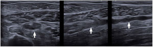 Varón de 27 años, que ingresa tras desembarcar en patera por edema de miembro inferior derecho y elevación del dímero D. Se realiza ecografía Doppler donde se objetiva ocupación de la luz de vena tibial posterior (flechas blancas) por trombo.