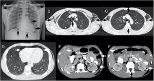 Varón de 15 años, llegado en patera, que ingresa por fascitis necrosante del tobillo derecho. La radiografía de tórax realizada por protocolo muestra como hallazgo incidental la presencia de enfisema subcutáneo, neumomediastino y neumoperitoneo (A). La TC de tórax con ventana de pulmón confirma el efecto Macklin con presencia de colecciones aéreas lineales disecando las vainas peribroncovasculares (asteriscos blancos) en ambos lóbulos superiores (B), asociado a enfisema subcutáneo y neumomediastino (B y C), neumorraquis (flechas negras) (C) y neumopericardio (flechas blancas) (D). La TC de abdomen con ventana de partes blandas muestra neumoperitoneo y retroneumoperitoneo (flechas blancas) (E y F), y confirma la presencia de neumorraquis (flecha negra) a distintos niveles (flecha negra) (F).