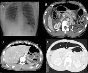 Caso 1: Varón de 40 años, llegado en patera, con abdomen agudo, hipotenso, taquicárdico, con ácido láctico elevado. A) Radiografía de tórax/abdomen en la que se observa neumoperitoneo (asterisco blanco). B) En la TC con CIV, se aprecia neumoperitoneo (flecha blanca), abundante líquido libre (asterisco blanco) y perforación en la primera porción duodenal (flecha negra), en probable relación con ulcus perforado, confirmado en la cirugía. Caso 2: Varón de 30 años, llegado en patera, ingresa con sospecha de shock séptico, con presencia de líquido libre en ecografía abdominal. C) En la TC se identifica perforación de pared posterior gástrica (flecha blanca), así como abundante neumoperitoneo (asterisco blanco) y líquido libre (flecha negra). Caso 3: Varón de 16 años, llegado en patera, con síncope y parada cardiorrespiratoria recuperada, con distensión abdominal. D) En la TC se observa abundante neumoperitoneo (asterisco blanco) y líquido libre (asterisco negro) sin identificar punto de perforación gastrointestinal. En la cirugía, se objetiva perforación pospilórica.