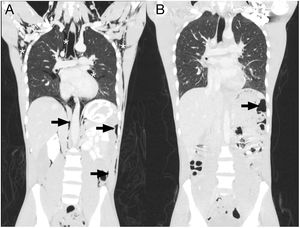 Varón de 15 años, llegado en patera, con cuadro de dolor abdominal, vómitos en posos de café, fiebre y deshidratación. Se realiza TC en la que se observa neumoperitoneo (flechas negras) sin perforación gastrointestinal. Presenta también, abundante neumomediastino, neumopericardio y enfisema subcutáneo (asteriscos blancos). En la TC de control, tras una semana con manejo conservador, se observa una marcada mejoría de estos hallazgos.