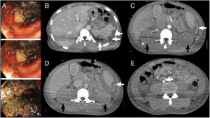 Varón de 23 años migrante con shock séptico y fracaso renal agudo. Además, presenta rectorragia y datos de colitis isquémica en colonoscopia (A) con dudas de perforación por lo que se realiza una TC de abdomen/pelvis con contraste intravenoso en fase portal, donde no se observan signos de perforación, pero sí se observa: B-D) Infartos esplénicos. C y D) Hipocaptación global de ambos riñones tanto en fase arterial como portal sugestivo de isquemia renal (flechas negras). E) TC abdomen/pelvis con CIV en fase portal donde se visualiza catéter venoso central en vena cava inferior con trombo adherido (flecha blanca).