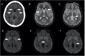 Varón de 33 años que ingresa tras desembarcar en patera por deshidratación hipernatrémica y deterioro del nivel de conciencia. La TC de cerebro sin contraste muestra áreas de hipodensidad y desdiferenciación afectando de forma bilateral y simétrica a ambos núcleos caudados y lenticulares (flechas blancas) (A). La RM realizada posteriormente confirma la existencia de áreas con hiperintensidad de señal en núcleos caudados y lenticulares en secuencia ponderada en T2 (B y C) y FLAIR (D y E), así como en el margen posterior de ambos tálamos (C y E), con hiperseñal en difusión (F), las cuales no mostraban restricción en el mapa ADC ni realce tras administración de contraste.