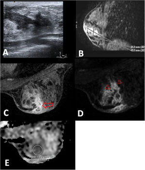 Mastitis periductal en una paciente de 26 años. A) La ecografía muestra ectasia ductal con contenido ecogénico en la mama derecha. B) Reconstrucción sagital que muestra el realce de tipo no masa de distribución segmentaria que ocupa un área de 45mm. C-E) Imagen de RM poscontraste, primera fase, T1 con saturación grasa (C) y sustracción (D), muestra la ectasia ductal con captación mural (flecha) y patrón en anillos agrupados (cabezas de flecha). E) El mapa de CDA muestra uno de los 3 valores estudiados, cuyo promedio fue 1,133×10-3mm2/s. Nótese el engrosamiento cutáneo focal hipercaptante próximo al área inflamatoria (C y D).