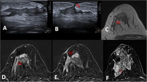Mastitis granulomatosas idiopática en una paciente de 40 años. A y B) La ecografía muestra ectasia ductal con contenido ecogénico en la mama derecha, con una fístula cutánea (flecha). C) Imagen de RM en T2 que muestra las paredes del ducto engrosadas con un contenido hiperintenso (flecha). D y E) Imagen de RM poscontraste, T1 con saturación grasa y sustracción, muestran la ectasia ductal con captación mural (flecha en D) y el trayecto fistuloso a la piel (flecha en E) con engrosamiento e hipercaptación cutánea focal. F) El área inflamatoria consiste en un realce de tipo no masa de distribución segmentaria y patrón en anillos agrupados (cabeza de flecha) que ocupa un área de 45mm. El mapa de CDA mostró un promedio de 1,008×10-3mm2/s. (no mostrado).