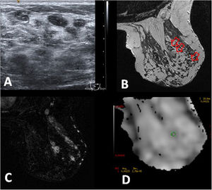 Mastitis granulomatosa idiopática en una paciente de 42 años. A) La ecografía mostró pseudoquistes menores de 1cm en la mama derecha. B) Imagen de RM en T2 que muestra múltiples nódulos menores de 1cm hiperintensos (flechas). C) Imagen de RM poscontraste, T1 con saturación grasa y sustracción, muestra captación de tipo no masa con distribución regional y patrón en anillos agrupados que se relacionan con los nódulos hiperintensos en T2 y corresponden a microabscesos. D) El mapa de CDA muestra uno de los 3 valores estudiados, cuyo promedio fue 1,352×10-3mm2/s.
