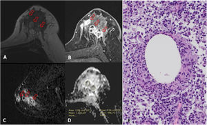 Mastitis granulomatosa quística neutrofílica en una paciente de 36 años. La ecografía mostró múltiples nódulos hipoecogénicos que asociaron señal Doppler (no mostrado). A) Imagen RM en T2 que muestra nódulos hiperintensos (flechas). B y C) Imágenes de RM poscontraste, T1 con saturación grasa (B) y reconstrucción sagital en sustracción (C), que muestran un realce de tipo no masa con distribución en múltiples regiones y patrón en anillos agrupados (flechas). D) Se estudiaron 3 valores de CDA cuyo promedio fue 1,221×10-3mm2/s. E) La anatomía patológica muestra presencia de histiocitos epitelioides formando un granuloma no necrotizante con un espacio quístico central y presencia de neutrófilos a su alrededor en un contexto inflamatorio de predominio linfoplasmocitario (20×). La PCR para Corynebacterium kroppenstedtii fue positiva.