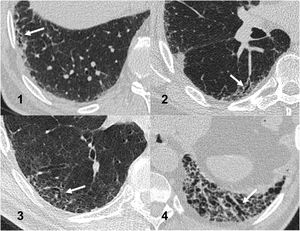 Ejemplos de los cuatro grados usados para la graduación de las bronquiectasias. Las bronquiectasias (marcadas con flechas) se clasificaron como 1, correspondiendo a mínima dilatación bronquial limitada al pulmón subpleural más periférico; 2, pequeñas bronquiectasias, aunque evidentes; 4, dilatación notable de los bronquios, y 3, tamaño de las bronquiectasias entre los grados2 y4.