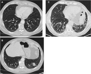 Imágenes representativas de alteraciones intersticiales pulmonares (AIP) con patrón fibrótico subpleural. Varón de 64años con cáncer de pulmón del lóbulo inferior izquierdo (puntas de flecha en B) y AIP subpleural fibrótica manifestada por reticulación subpleural basal y pequeñas bronquiectasias de tracción (flechas en A y B; TC realizada en febrero de 2013). En ese momento, y después de la cirugía, el paciente estaba asintomático y tenía pruebas de función pulmonar normales. Siete años más tarde experimentó un empeoramiento clínico progresivo y deterioro funcional, con una TC realizada en septiembre de 2020 (C) que mostró una progresión evidente de la enfermedad con extensión a todos los lóbulos (flechas).