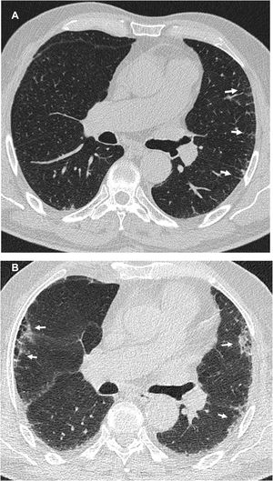 Imágenes representativas de alteraciones intersticiales pulmonares con patrón subpleural no fibrótico. Varón de 74años con fibrosis pulmonar idiopática. La TC inicial en septiembre de 2007 (A) mostró reticulación sin bronquiectasias ni panal en la zona media del pulmón izquierdo (flechas). Estaba asintomático. No se realizó otra TC hasta febrero de 2018 (B), momento en que presentaba tos y disnea, y se observó una extensa reticulación con distorsión arquitectural y bronquiectasias por tracción (flechas).