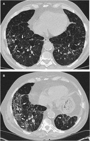 Imágenes representativas de alteraciones intersticiales pulmonares con patrón no subpleural. Varón de 72años con fibrosis pulmonar idiopática confirmada histológicamente. La TC en enero de 2010 (A) mostró sutiles opacidades en vidrio deslustrado, con engrosamiento septal y reticulación limitados al pulmón más basal bilateralmente (flechas). Tenía un tumor maligno en el pulmón izquierdo que fue tratado quirúrgicamente mediante lobectomía inferior izquierda, que además confirmó un patrón de NIU en la muestra quirúrgica. Después de eso, en mayo de 2014 experimentó disnea progresiva, y la TC (B) mostró una enfermedad pulmonar fibrosante progresiva (flechas).