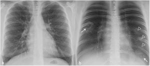 Radiografía de tórax (a) y tomosíntesis digital torácica (TDT) (b) en un paciente con signo de la diana (flechas blancas), visible solo en la TDT; también se visualizan opacidades en vidrio deslustrado en el pulmón izquierdo (cabezas de flecha en b) por neumonía COVID-19.