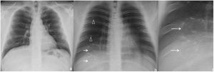 Radiografía de tórax (a) y tomosíntesis digital torácica (TDT) (b y c) en un paciente con el signo de la diana (flechas blancas) visible solo en la TDT. Se objetivan dos SD adyacentes con anillos de opacidad periféricos compartidos (b y c). Opacidades mal definidas, parcheadas, periféricas, en vidrio deslustrado (cabezas de flecha) por neumonía COVID-19.