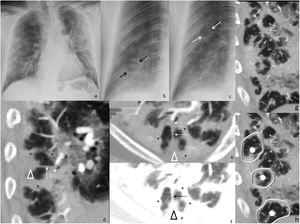 Radiografía de tórax (a) y tomosíntesis digital torácica (TDT) (b y c) de un paciente con el signo de la diana múltiple (flechas blancas) visibles solo en la TDT. Reconstrucciones curvas de angio-TC de arterias pulmonares con ventana angiográfica (d y e) y de pulmón (f, mismo plano que e), donde se observan arterias periféricas con material trombótico endoluminal (flechas discontinuas), cuya porción distal (flecha continua) llega hasta el nódulo central del signo de la diana (cabezas de flecha); los asteriscos marcan el anillo denso periférico. En las imágenes (g y h) se ponen de manifiesto múltiples anillos densos periféricos compartidos (líneas blancas) que rodean al pulmón normal y muestran el nódulo central (círculos blancos), que mostró un paciente con signo de la diana en una neumonía COVID-19 asociada a tromboembolia pulmonar.
