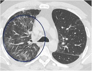 Imagen axial de TCAR (ventana de pulmón) en un paciente 18meses después de una neumonía por SARS-CoV-2 que muestra áreas parcheadas de vidrio deslustrado en el lóbulo superior derecho (círculo), así como una ligera dilatación de algunas estructuras bronquiales centrales.
