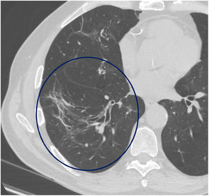 Imagen axial de TCAR (ventana de pulmón) centrada en el lóbulo inferior derecho que muestra distorsión de la arquitectura caracterizada por desplazamiento anómalo de los vasos y bronquios por afectación del parénquima adyacente (círculo).