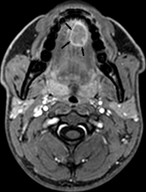 Varón de 17 años con una lesión indurada y adherida en la cara ventral de la lengua. La RM en secuencia T1-TEG con supresión grasa poscontraste demuestra un nódulo en 1/3 anterior izquierdo de la lengua con realce heterogéneo (flechas). El diagnóstico anatomopatológico fue de sarcoma sinovial. RM: resonancia magnética; TEG: turbo eco de gradiente.