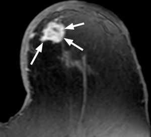 Mujer de 59 años que se palpa un nódulo en la mama izquierda. Biopsia guiada con ecografía y anatomía patológica de carcinoma ductal infiltrante. La RM preneoadyuvancia en secuencia T1-TEG con supresión grasa poscontraste evidencia el nódulo único con realce intenso en la fase arterial (flechas). RM: resonancia magnética; TEG: turbo eco de gradiente.