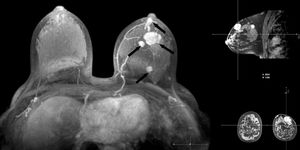 Mujer de 42 años con mamas muy densas. Nódulo en la mama izquierda biopsiado mediante control ecográfico con anatomía patológica de carcinoma ductal infiltrante. La RM preneoadyuvancia T1-TEG con supresión grasa poscontraste demuestra el nódulo biopsiado y nódulos múltiples dispersos con realce intenso en la fase arterial (flechas). RM: resonancia magnética; TEG: turbo eco de gradiente.