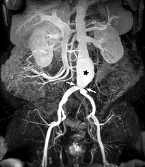 Varón de 80 años. La angio-RM T1-TEG 3D en el plano coronal demuestra un aneurisma fusiforme infrarrenal (asterisco) y estenosis en confluencia aorto-iliaca (flechas). Angio-RM: angiografía por resonancia magnética; TEG: turbo eco de gradiente.