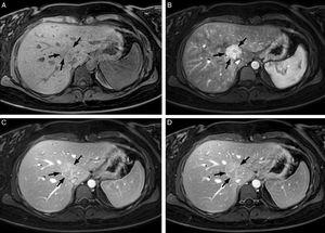 Mujer de 25 años con ictericia y colestasis. La RM hepática, secuencia T1-TEG con supresión de grasa (a) sin contraste y poscontraste (b) en fase arterial, portal (c) y equilibrio (d), demuestra una masa de 36mm en el segmento VIII (flechas), bien delimitada, con realce intenso y heterogéneo, con centro hipointenso en la fase arterial, que en las fases portal y de equilibrio se hace mayoritariamente isointensa con alguna zona central que permanece hiperintensa, en relación con hiperplasia nodular focal. RM: resonancia magnética; TEG: turbo eco de gradiente.