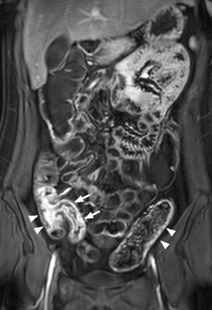Mujer de 20 años. La RM intestinal con CGd demuestra un realce de la pared de un segmento de 7cm de íleon terminal (flechas) y de 8cm de ciego y colon ascendente (punta de flecha) y realce en la pared del colon descendente (puntas de flecha), por enfermedad de Crohn, con actividad inflamatoria. CGd: contraste de gadolinio; RM: resonancia magnética.