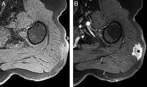 Varón de 65 años con una masa en el hombro izquierdo. La RM T1-TEG (a) sin contraste y (b) poscontraste en la fase arterial demuestra una masa (asterisco) de 3 x 2cm, de contorno irregular, en tejido celular subcutáneo que infiltra la fascia y el compartimento muscular. El diagnóstico anatomopatológico fue de linfoma. RM: resonancia magnética; TEG: turbo eco de gradiente.