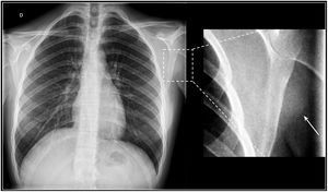 Radiografía convencional. Adolescente de 16 años que consultó por una tumoración de lento crecimiento en la región axilar izquierda, asociando dolor referido a la escápula y parestesias. Diagnóstico final de SS. Radiografía de tórax en proyección postero-anterior (PA), donde se observa una imagen con densidad de partes blandas y morfología ovalada en la axila izquierda (flecha).