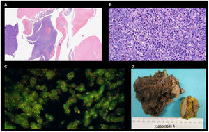 Anatomía patológica (adolescente de 16 años con SS multiquístico en la región axilar izquierda). A: H&E (panorámica). Se observa componente celular, fibrosis y áreas necrótico-hemorrágicas. B: H&E (x400). Componente de tejido celular mesenquimal de tipo monofásico-fusocelular. C: FISH. Se evidencia positividad fuerte para t(X:18) (SS18:SSX2), representado con los puntos fluorescentes rojos y verdes. D: aspecto macroscópico. Tumoración lobulada con áreas quísticas; se observa un segundo fragmento de aspecto sólido (cirugía laboriosa por localización profunda y adherencia a tejidos blandos).